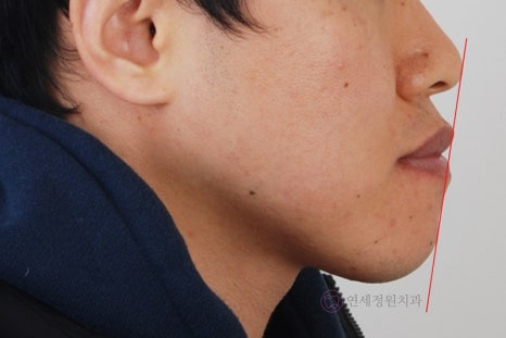 주걱턱 치아 교정만으로 치료 가능할까요? @ 대치동 교정치과 연세정원치과 관련 이미지 10