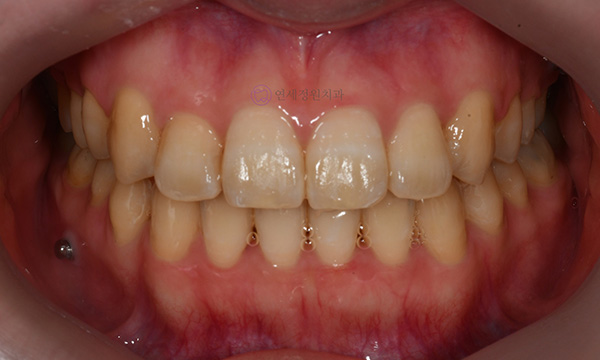 치아 중심선이 안 맞아요! 치아 비대칭 교정으로 가능할까요? @ 대치동 교정치과 연세정원치과 관련 이미지 29