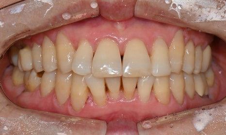 대치동 치경부 레진 & 중년교정 & 치아미백으로 자연스러운 미소를! 관련 이미지 8