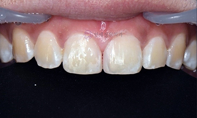 Front Tooth Resin Treatment in Korea: Microdontia, Gaps & Black Triangles 관련 이미지 9