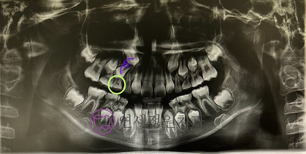 소아교정의 중요성 : 적절한 시기에 유치를 빼주는 것이 중요한 이유 @ 대치동 교정치과 연세정원치과 관련 이미지 5