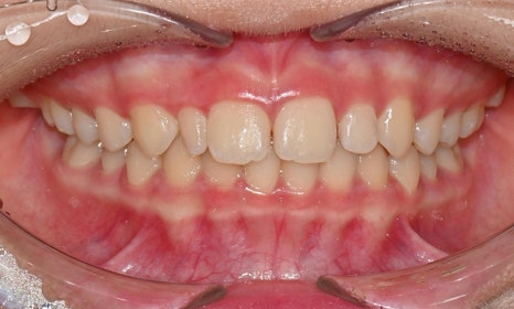 왜소치 치료 - 라미네이트 vs 레진비니어 vs 치아교정 관련 이미지 21