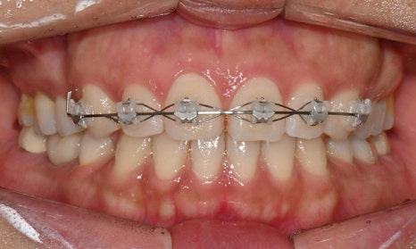 앞니 벌어짐 부분교정 (재교정) 관련 이미지 5