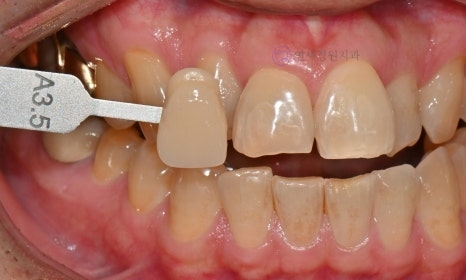 Precautions for Teeth Whitening Treatment @ Yonsei JW Dental Clinic 관련 이미지 8