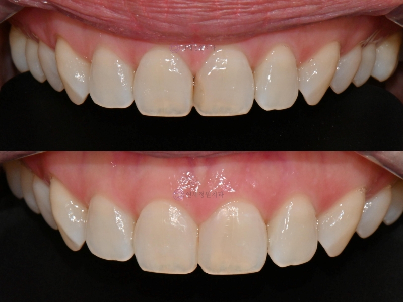 앞니 심미 레진 치료 : 블랙트라이앵글, 앞니 사이 공간 @ 대치동 연세정원치과 관련 이미지 14