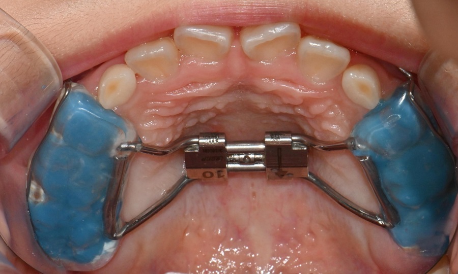 악궁확장을 통한 발치 없는 교정치료 관련 이미지 3