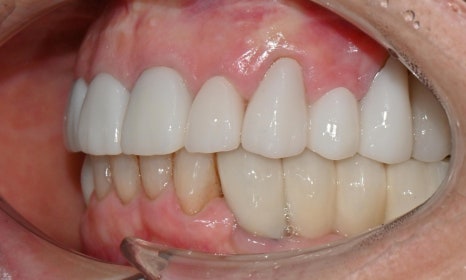 심미와 기능을 모두 고려한 앞니 심미보철 재치료 관련 이미지 10