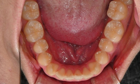 치아 중심선 비대칭과 아랫입술 돌출 개선 관련 이미지 7