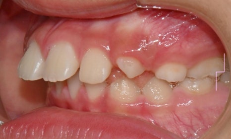 어린이 무턱 액티베이터 성장교정 후 인비절라인 퍼스트 관련 이미지 11