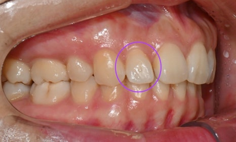 인비절라인 익스프레스 부분교정 <앞니 재교정> 관련 이미지 6