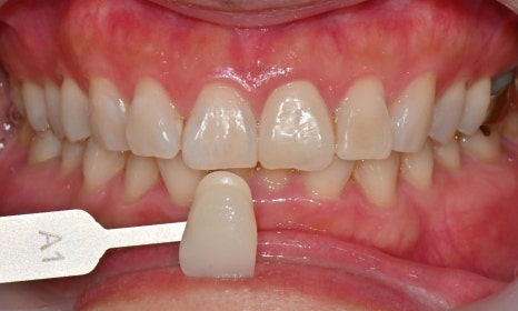원데이 치아미백 - 앞니 크라운 사례 관련 이미지 3