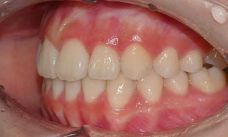 고등학생 인비절라인 교정｜앞니 치아배열 &middot; 과개교합 관련 이미지 19