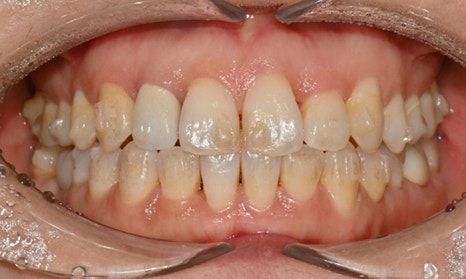 Teeth Whitening After Orthodontic Treatment at Yonsei JW Dental Clinic image 4