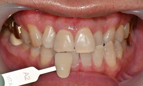 Precautions for Teeth Whitening Treatment @ Yonsei JW Dental Clinic 관련 이미지 9