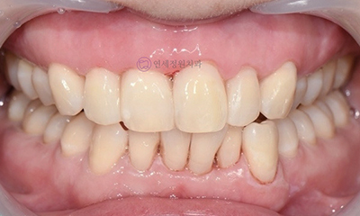 Front Tooth Resin Treatment in Korea: Microdontia, Gaps & Black Triangles 관련 이미지 13
