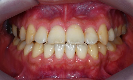 주걱턱 치아 교정만으로 치료 가능할까요? @ 대치동 교정치과 연세정원치과 관련 이미지 8