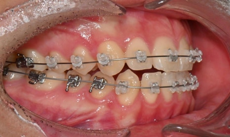 치아 중심선 비대칭과 아랫입술 돌출 개선 관련 이미지 9