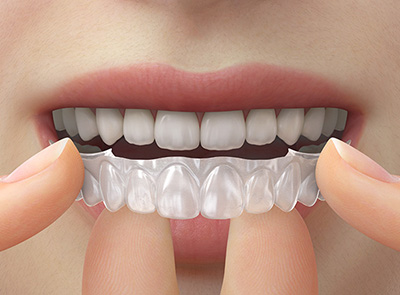 Teeth Whitening After Orthodontic Treatment at Yonsei JW Dental Clinic image 11