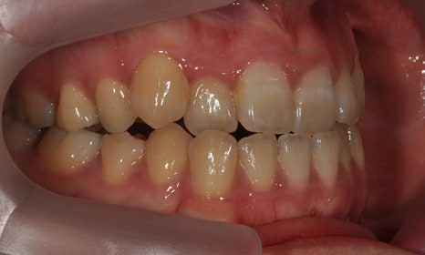 치아 중심선이 안 맞아요! 치아 비대칭 교정으로 가능할까요? @ 대치동 교정치과 연세정원치과 관련 이미지 22