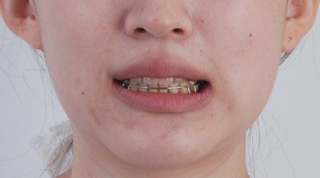 치아 중심선이 안 맞아요! 치아 비대칭 교정으로 가능할까요? @ 대치동 교정치과 연세정원치과 관련 이미지 26