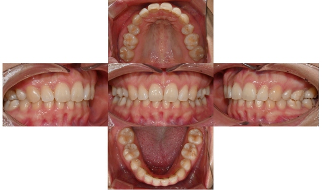 인비절라인 익스프레스 부분교정 <앞니 재교정> 관련 이미지 7