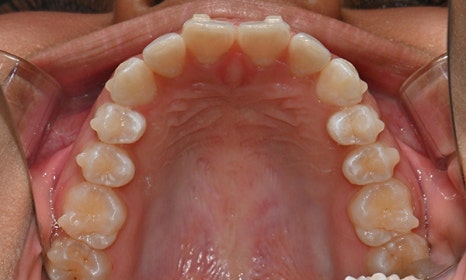 인비절라인 앞니 사이 공간 및 덧니 교정 관련 이미지 10