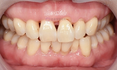 Front Tooth Resin Treatment in Korea: Microdontia, Gaps & Black Triangles 관련 이미지 4