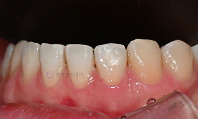 ICON Resin Treatment: White Spots on Front Teeth - Are They Cavities? 관련 이미지 10