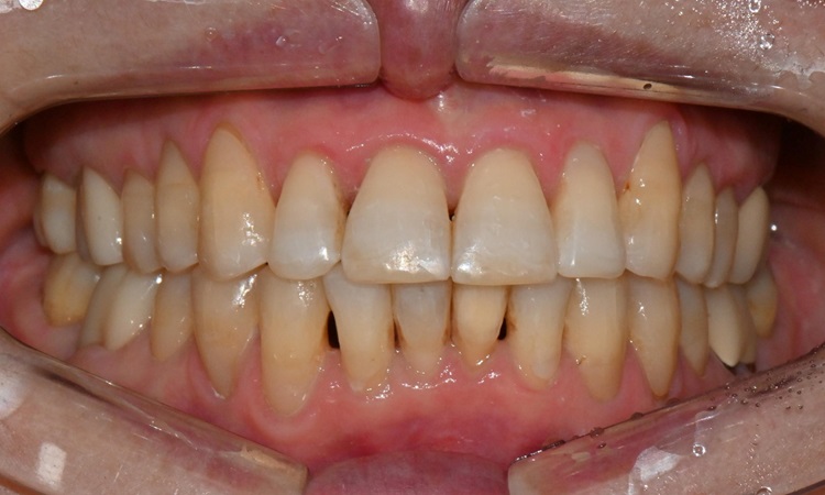 대치동 치경부 레진 & 중년교정 & 치아미백으로 자연스러운 미소를! 관련 이미지 14