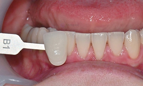 Teeth Whitening Case : A couple from the Netherlands 관련 이미지 12