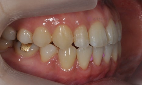 치아 중심선이 안 맞아요! 치아 비대칭 교정으로 가능할까요? @ 대치동 교정치과 연세정원치과 관련 이미지 19