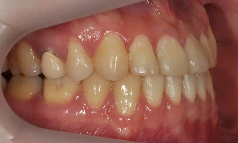비대칭 및 돌출입 치아교정, 대치동 교정치과 연세정원치과 관련 이미지 5