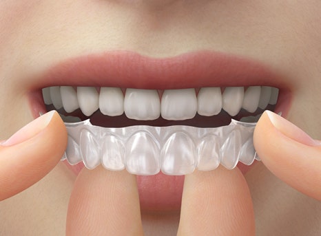 교정 치료 후 치아 미백 관련 이미지 11