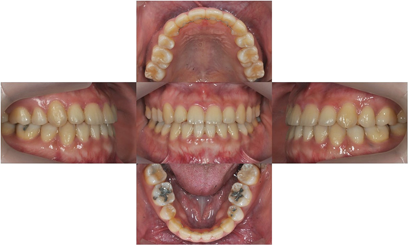 비수술 주걱턱 교정, 대치동 교정치과 연세정원치과 관련 이미지 5