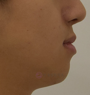 비대칭 및 돌출입 치아교정, 대치동 교정치과 연세정원치과 관련 이미지 12