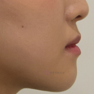 비수술 주걱턱 교정, 대치동 교정치과 연세정원치과 관련 이미지 9