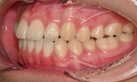 치아 중심선 비대칭과 아랫입술 돌출 개선 관련 이미지 5