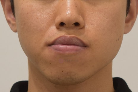 주걱턱 치아 교정만으로 치료 가능할까요? @ 대치동 교정치과 연세정원치과 관련 이미지 5