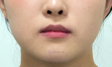 비수술 주걱턱 교정, 대치동 교정치과 연세정원치과 관련 이미지 6
