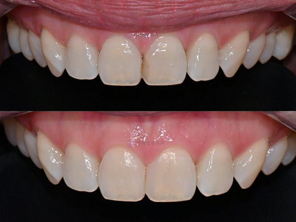 Dental Bonding for Gaps Between Front Teeth & Black Triangles | Gangnam, Seoul 관련 이미지 14