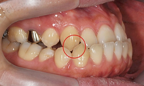 주걱턱 치아 교정만으로 치료 가능할까요? @ 대치동 교정치과 연세정원치과 관련 이미지 3