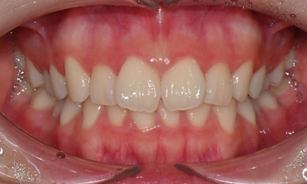 고등학생 인비절라인 교정｜앞니 치아배열 &middot; 과개교합 관련 이미지 2