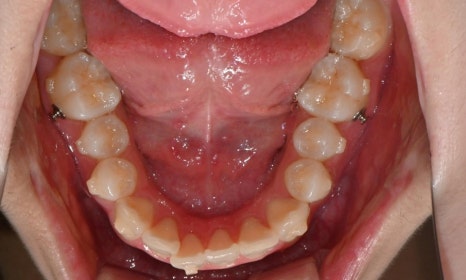 고등학생 인비절라인 교정｜앞니 치아배열 &middot; 과개교합 관련 이미지 11