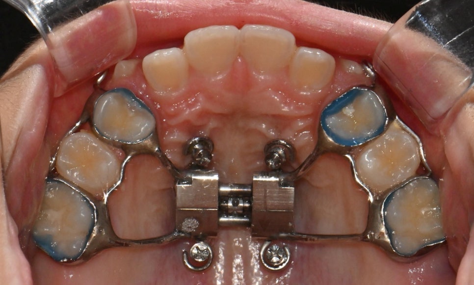 악궁확장장치(RPE, MARPE, MSE) 돌리는 방법 관련 이미지 6