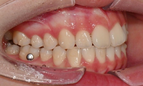 고등학생 인비절라인 교정｜앞니 치아배열 &middot; 과개교합 관련 이미지 13