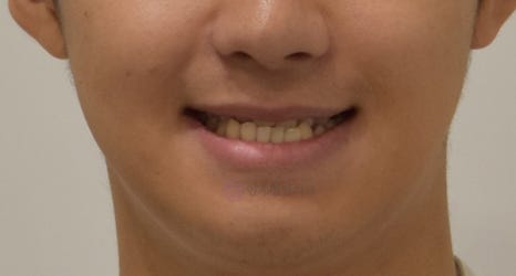 비대칭 및 돌출입 치아교정, 대치동 교정치과 연세정원치과 관련 이미지 10