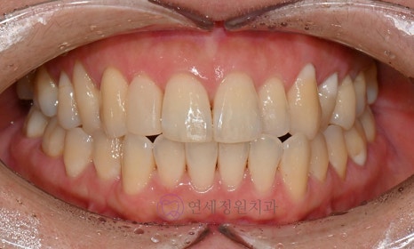 왜소치 치료 - 라미네이트 vs 레진비니어 vs 치아교정 관련 이미지 9