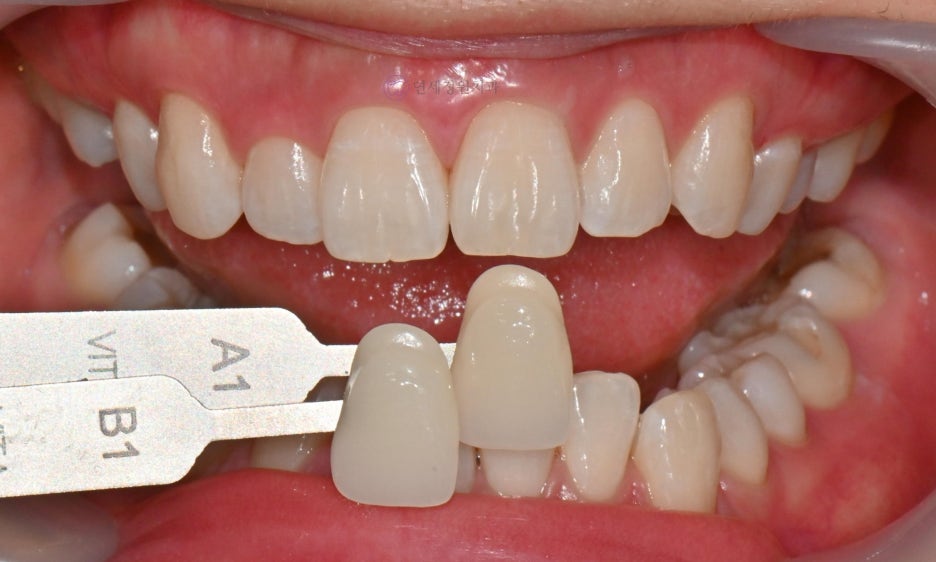 One Day Teeth Whitening Process @ Yonsei JW Dental Clinic 관련 이미지 18