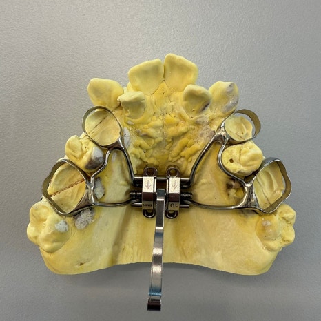 악궁확장장치(RPE, MARPE, MSE) 돌리는 방법 관련 이미지 15