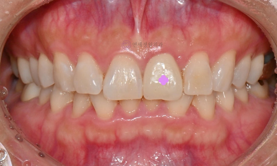 원데이 치아미백 - 앞니 크라운 사례 관련 이미지 2